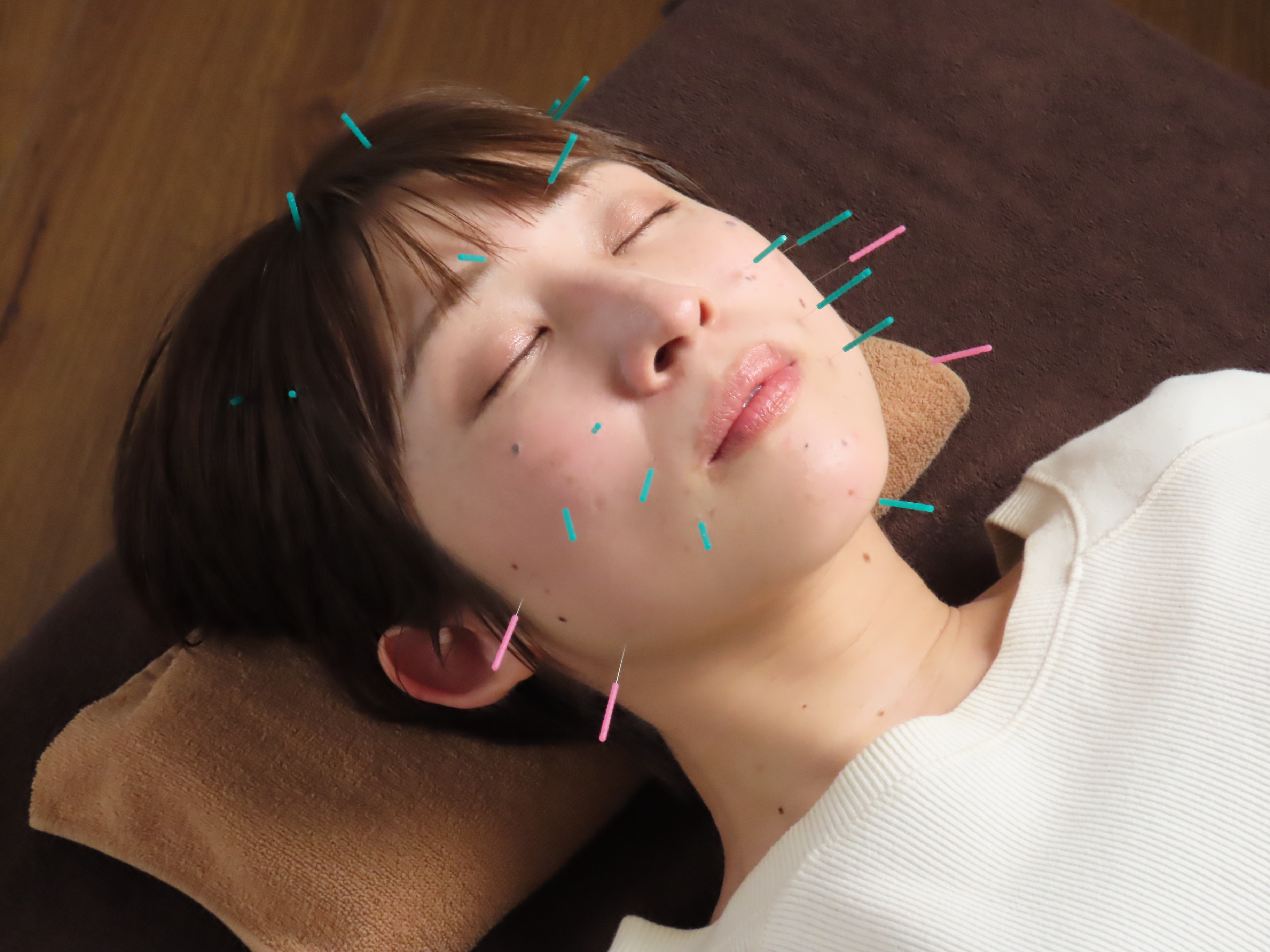 小顔美容鍼の施術